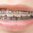 歯並びは気になるけど、本格矯正はちょっと…という方に